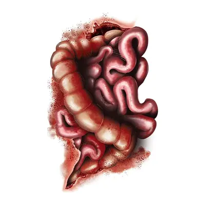 Intestinos expostos